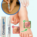 Orvelle Nail Fungus